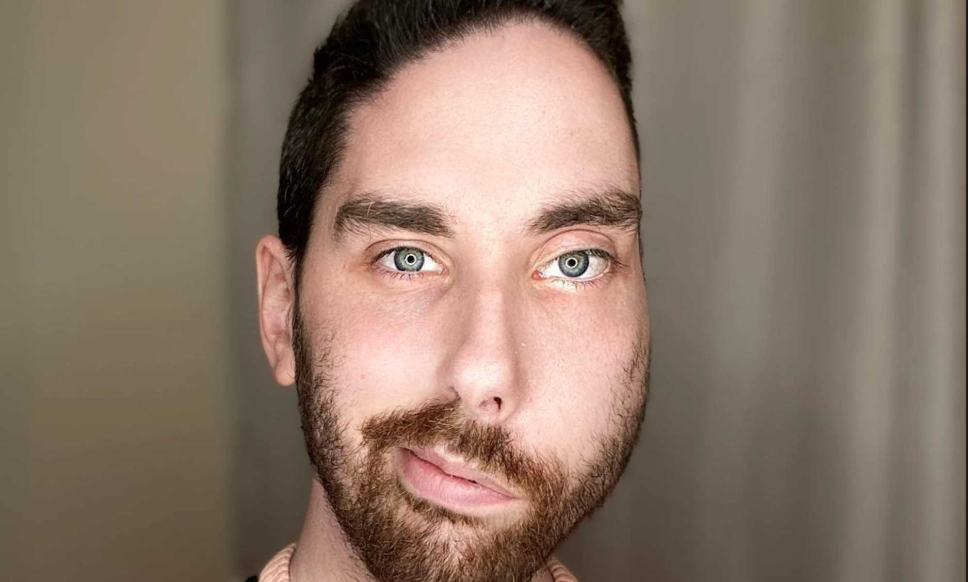 Social media star, Antoll Mills, uses his platform to educate people on visible differences.