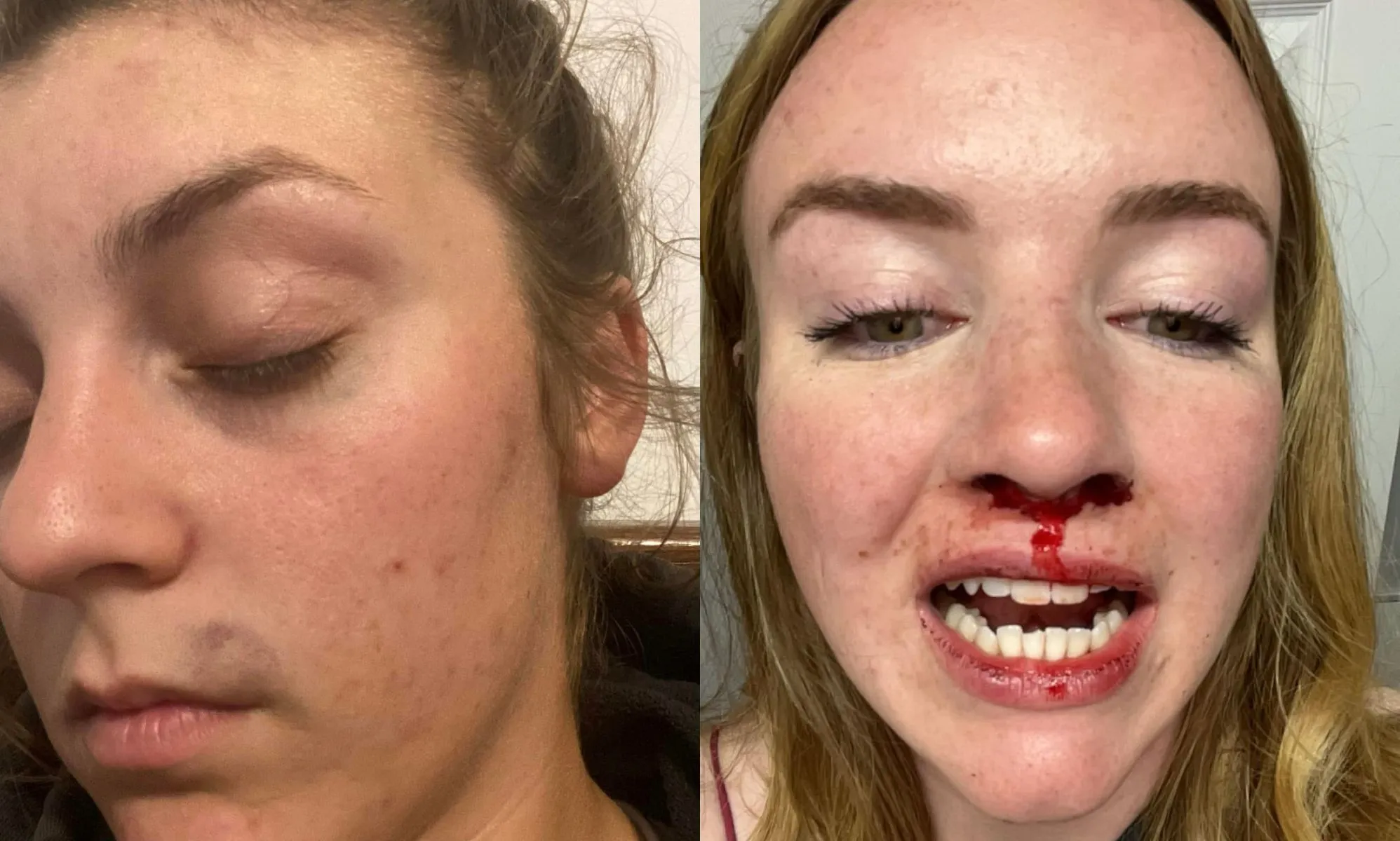 Pictures of the injuries that Emma MacLean sustained following the alleged assault.